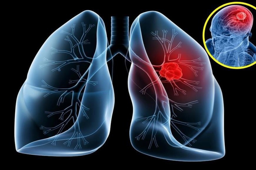 U phổi ác tính sống được bao lâu? - 1