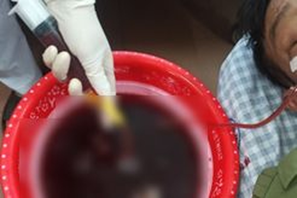 8 lần cấp cứu vẫn nghiện rượu, người đàn ông nôn cả lít máu - 1 8 lần cấp cứu vẫn nghiện rượu, người đàn ông nôn cả lít máu - 1