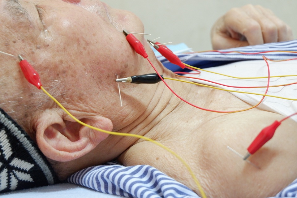 Xem bác sĩ dùng điện châm chữa liệt nửa người cho bệnh nhân đột quỵ - 8 Xem bác sĩ dùng điện châm chữa liệt nửa người cho bệnh nhân đột quỵ - 8