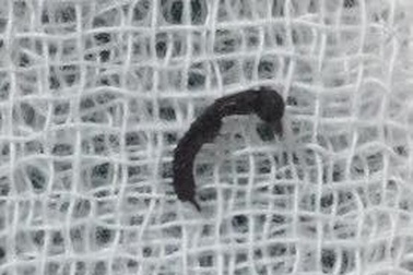 Kiến gặm nhấm thủng màng nhĩ bé gái 10 tuổi