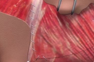 Công nghệ phẫu thuật giúp “cải lão hoàn đồng” được tiến hành thế nào?