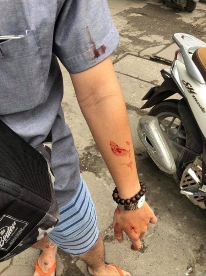 Người đi cùng nữ sinh viên H.G. bị đánh chảy máu mặt, máu rớt xuống cánh tay. (Ảnh: C.T.P.)