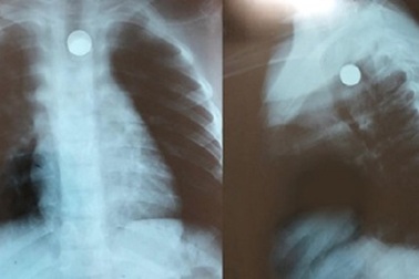 Bé trai gặp nạn khi ngậm viên bi sắt trong miệng