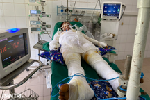 Xót xa hoàn cảnh người bố 4 con bị bỏng 85% cơ thể