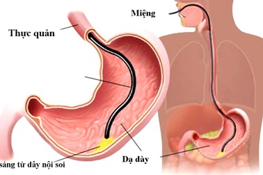 Nội soi dạ dày có ý nghĩa gì?