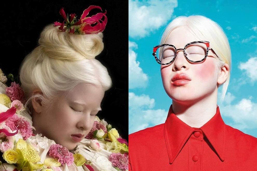 Cô gái bạch tạng từng bị cha mẹ bỏ rơi, trở thành người mẫu tạp chí Vogue - 4