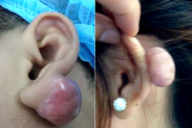 Sẹo lồi to bằng quả chanh chỉ vì bấm lỗ tai