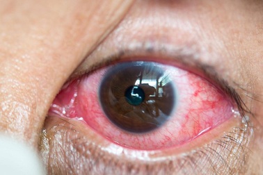 Nguy cơ nhiễm trùng mắt nghiêm trọng từ kính áp tròng