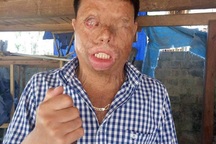 Cuộc sống khốn khổ của chàng trai có khuôn mặt biến dạng vì bị tạt axit nhầm
