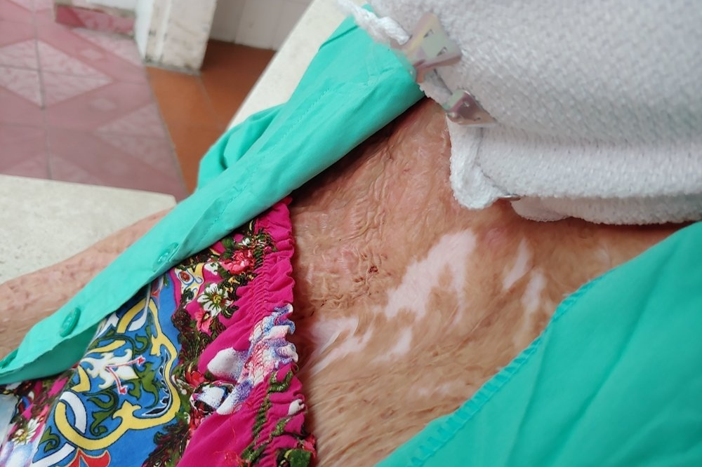 Hạnh phúc mới của người mẹ trẻ 5 năm sau khi bị chồng cũ châm lửa đốt - 2 Hạnh phúc mới của người mẹ trẻ 5 năm sau khi bị chồng cũ châm lửa đốt - 2