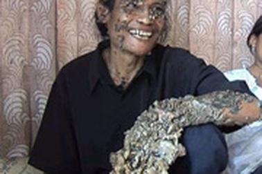 "Người cây" muốn tìm vợ