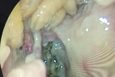 Ổ giòi hàng chục con làm tổ trong mũi bệnh nhân