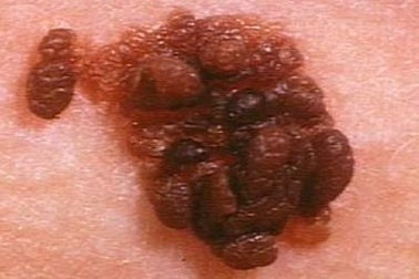 Phát triển thuốc trị ung thư da hiệu quả