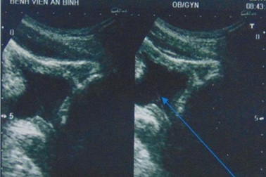 Tự lấy sỏi thận qua đường niệu bằng… cọng cỏ