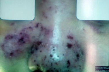 Đi làm đẹp dạo, thiếu nữ 17 tuổi suýt mất mũi