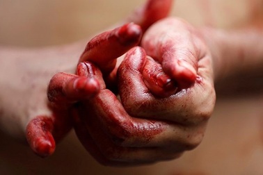 Lạ kỳ chuyện cô gái toát “mồ hôi máu”