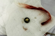 Bé gái 3 tuổi bị hoại tử vách ngăn mũi vì dị vật không ngờ trong đồ chơi