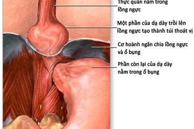 Ho ra máu do loét túi thoát vị dạ dày