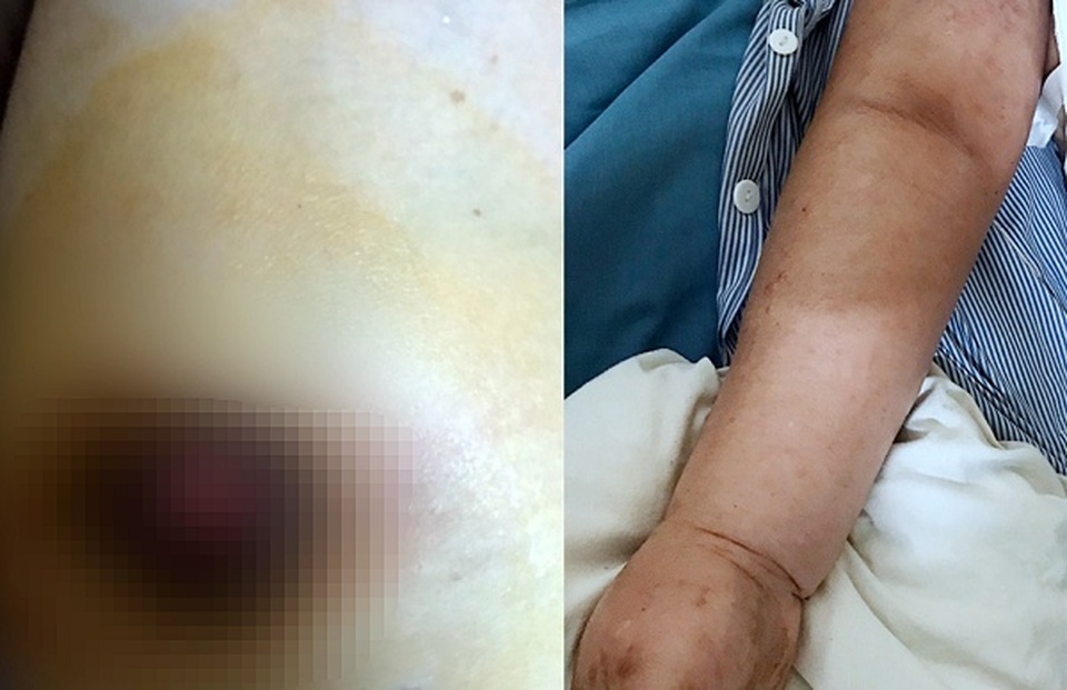 Vỡ loét đầu vú vì tự ý đắp lá chữa ung thư - 1 Vỡ loét đầu vú vì tự ý đắp lá chữa ung thư - 1
