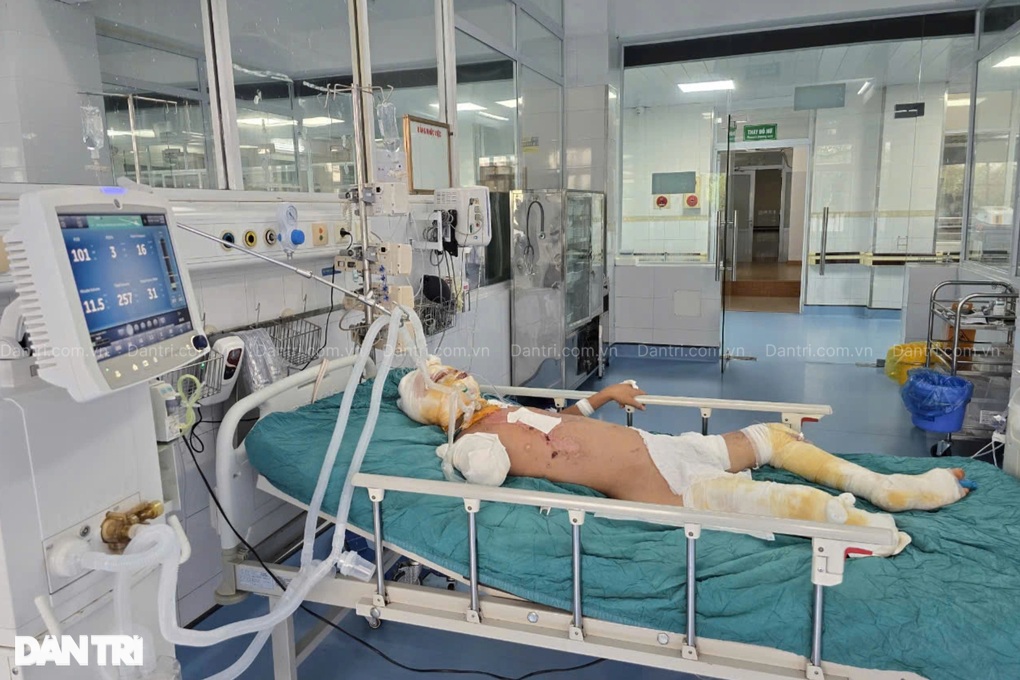 Bác sĩ kêu gọi giúp đỡ người đàn ông mất tay, chân bên phải vì điện cao thế - 5 Bác sĩ kêu gọi giúp đỡ người đàn ông mất tay, chân bên phải vì điện cao thế - 5