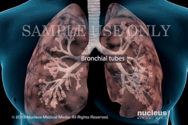 Trực quan quá trình tàn phá lá phổi của khói thuốc lá