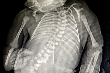 15 phút cuộc đời ngắn ngủi của em bé “người cá” sinh ra tại Ấn Độ