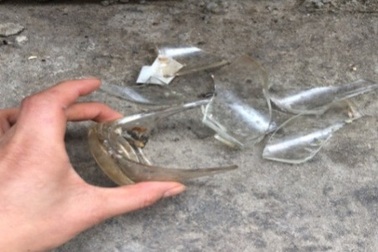 Toàn bộ ruột non bé gái chui ra ngoài ổ bụng sau tai nạn tưởng đơn giản