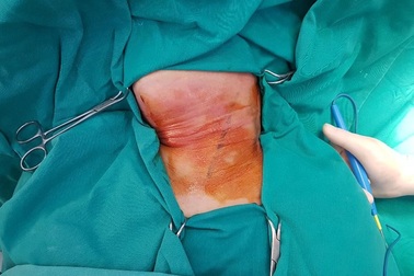 Người phụ nữ nguy kịch, đe doạ máu phun xối xả vì hóc xương cá