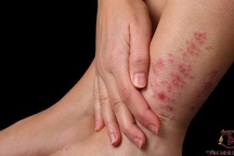 Bệnh phong có dễ lây?