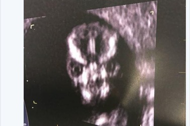 Thai nhi mang khuôn mặt như... chúa tể hắc ám hút hơn 32 nghìn lượt thích trên Twitter