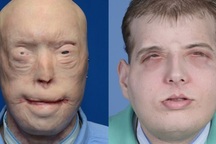 Ca ghép mặt và da đầu toàn diện trị giá triệu đô