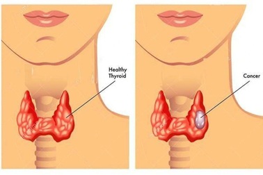 Điều trị I-131 trong ung thư tuyến giáp là gì?