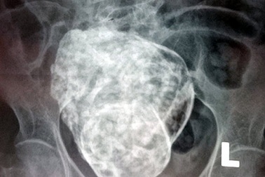 Một bà cụ 76 tuổi mang thai “đá” nhiều năm