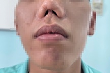Chàng trai biến dạng mũi 31 năm, chịu nhiều cuộc mổ vì hậu quả lúc sơ sinh