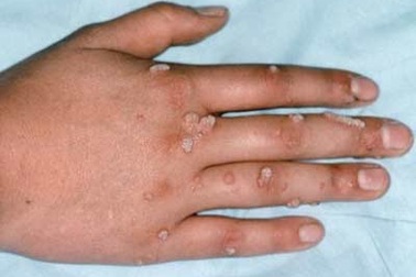 Không nên cậy mụn cóc