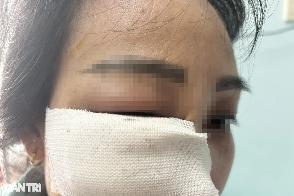 TPHCM: Đi thẩm mỹ quốc tế tiêm tan filler, bị biến chứng nặng - 3 TPHCM: Đi thẩm mỹ quốc tế tiêm tan filler, bị biến chứng nặng - 3
