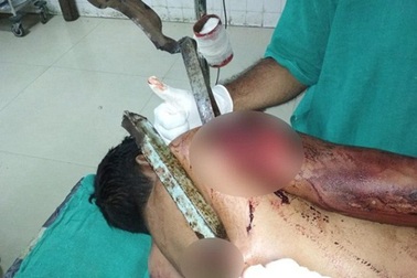 Sống sót thần kỳ sau khi bị thanh sắt dài 5 mét đâm xuyên người