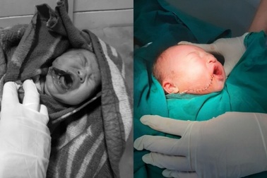 Đẻ tại nhà, bé gái bị rơi vào dao, cắt sâu vùng mặt