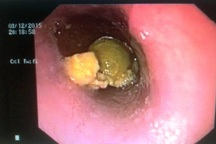 Sản phụ nguy kịch vì nuốt mật heo chữa đau bụng