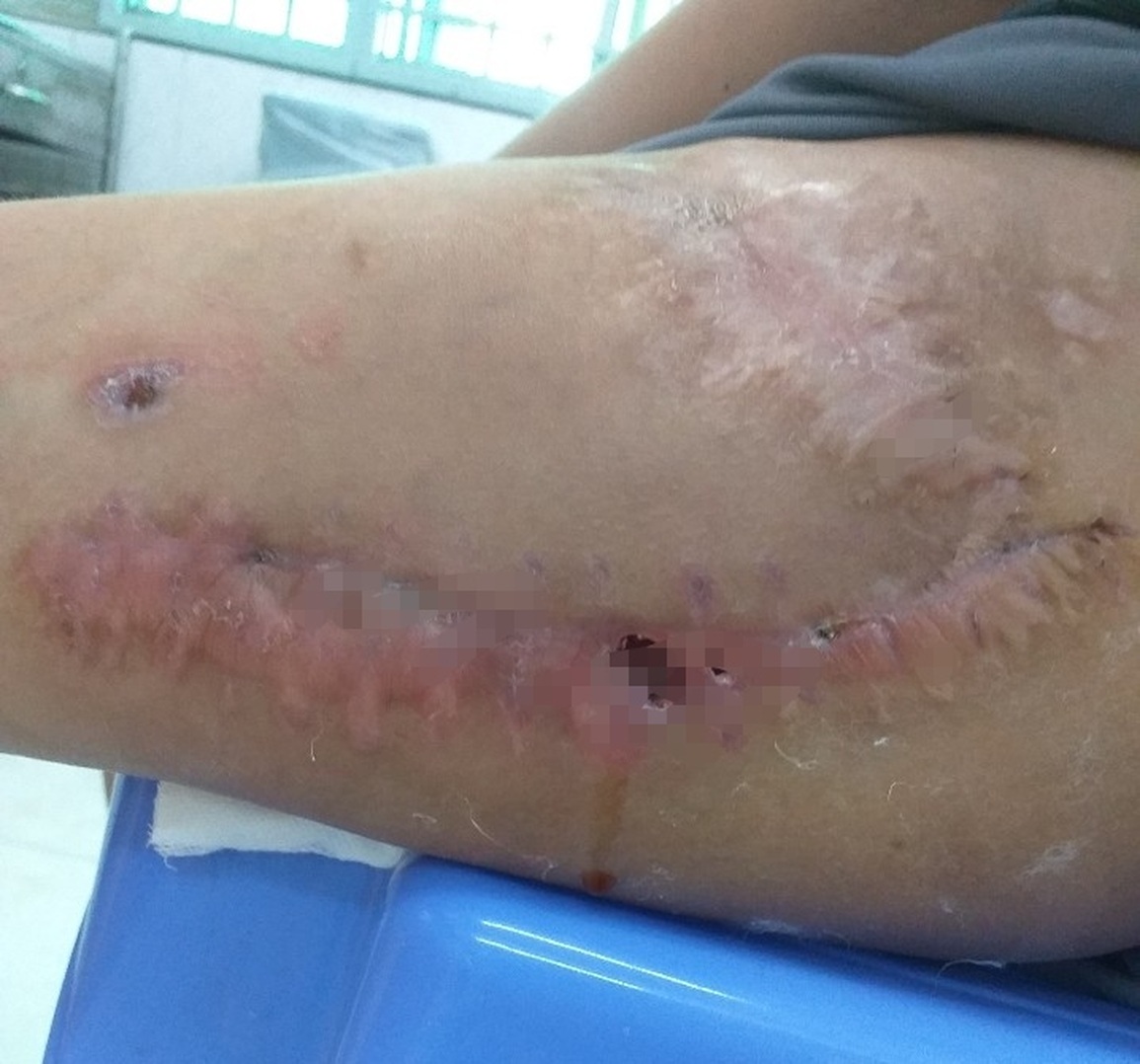 Thương cậu bé mồ côi 14 tuổi chỉ nặng 28kg vì khối u khủng ăn hết bên đùi - 2 Thương cậu bé mồ côi 14 tuổi chỉ nặng 28kg vì khối u khủng ăn hết bên đùi - 2