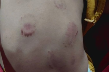 Bé gái 3 tuổi bị nhiều vết bầm tím, dấu răng trên người sau giờ học