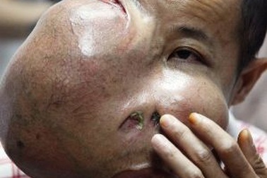 Gặp người đàn ông được gỡ bỏ khối u khổng lồ trên mặt
