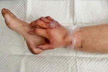 Vì sao bác sĩ phải ghép tạm tay đứt lìa vào chân cô gái mang song thai?