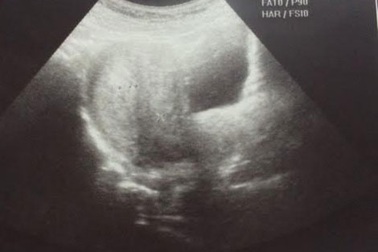 Bệnh nhân “tố” bác sĩ BV Phụ sản Trung ương cắt nhầm vòi trứng