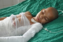 Lời cầu cứu của em bé dân tộc Phù Lá bị bỏng xăng