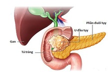 Phẫu thuật nội soi cắt khối tá tụy - Bước tiến mới trong điều trị ung thư vùng đầu tụy tá tràng