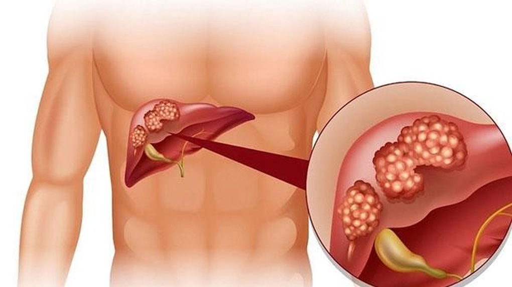 Ngăn chặn biến chứng nguy hiểm từ viêm gan do virus - 1 Ngăn chặn biến chứng nguy hiểm từ viêm gan do virus - 1