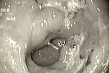 Những người nào có nguy cơ mắc ung thư dạ dày?