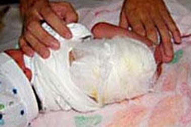 Bé 18 ngày tuổi bị bỏng do y tá đặt cạnh ấm nước đang sôi