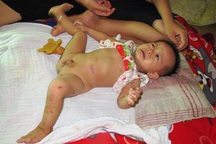 Xót xa trước bé 1 tuổi dị dạng bộ phận sinh dục